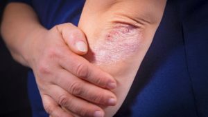 Schuppenflechte – Wenn das Immunsystem die Haut angreift