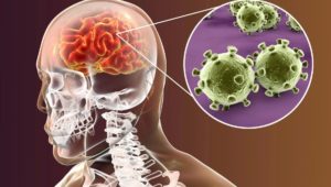 Demenz: Können Herpesviren Alzheimer auslösen?