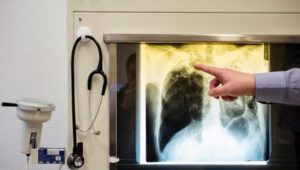 Tödliche Gefahr: Jährlich 5500 Tuberkulose-Fälle in Deutschland