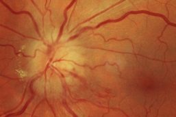 Schleier auf den Augen: Das sind die Anzeichen für einen Augeninfarkt