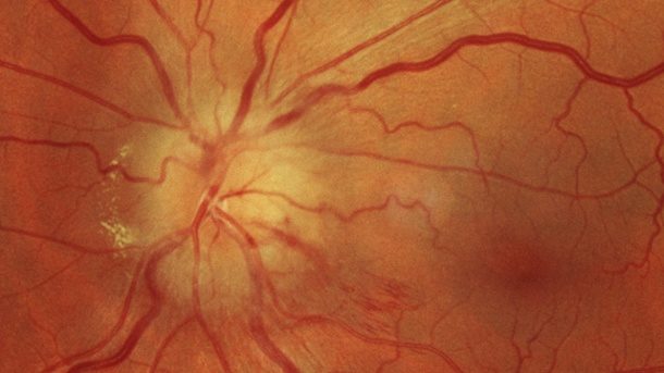 Schleier auf den Augen: Das sind die Anzeichen für einen Augeninfarkt